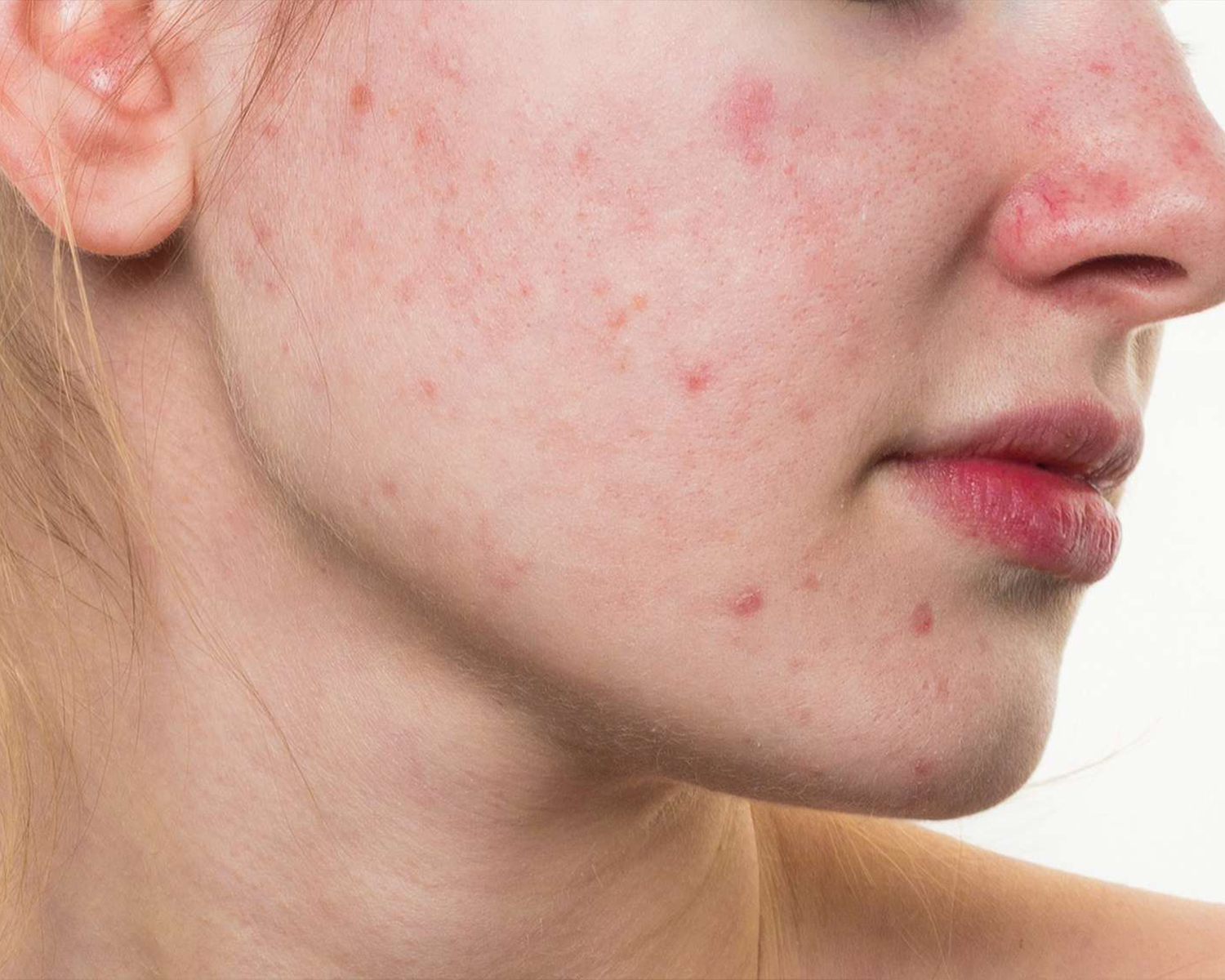 ¿Qué es el acné y cómo puedo tratarlo?