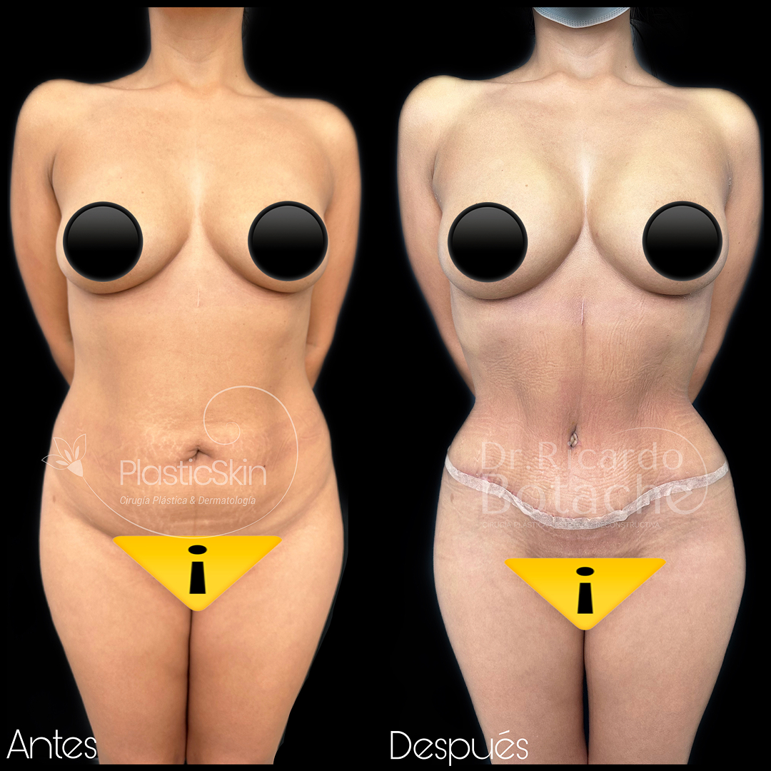 Contorno Abdominal