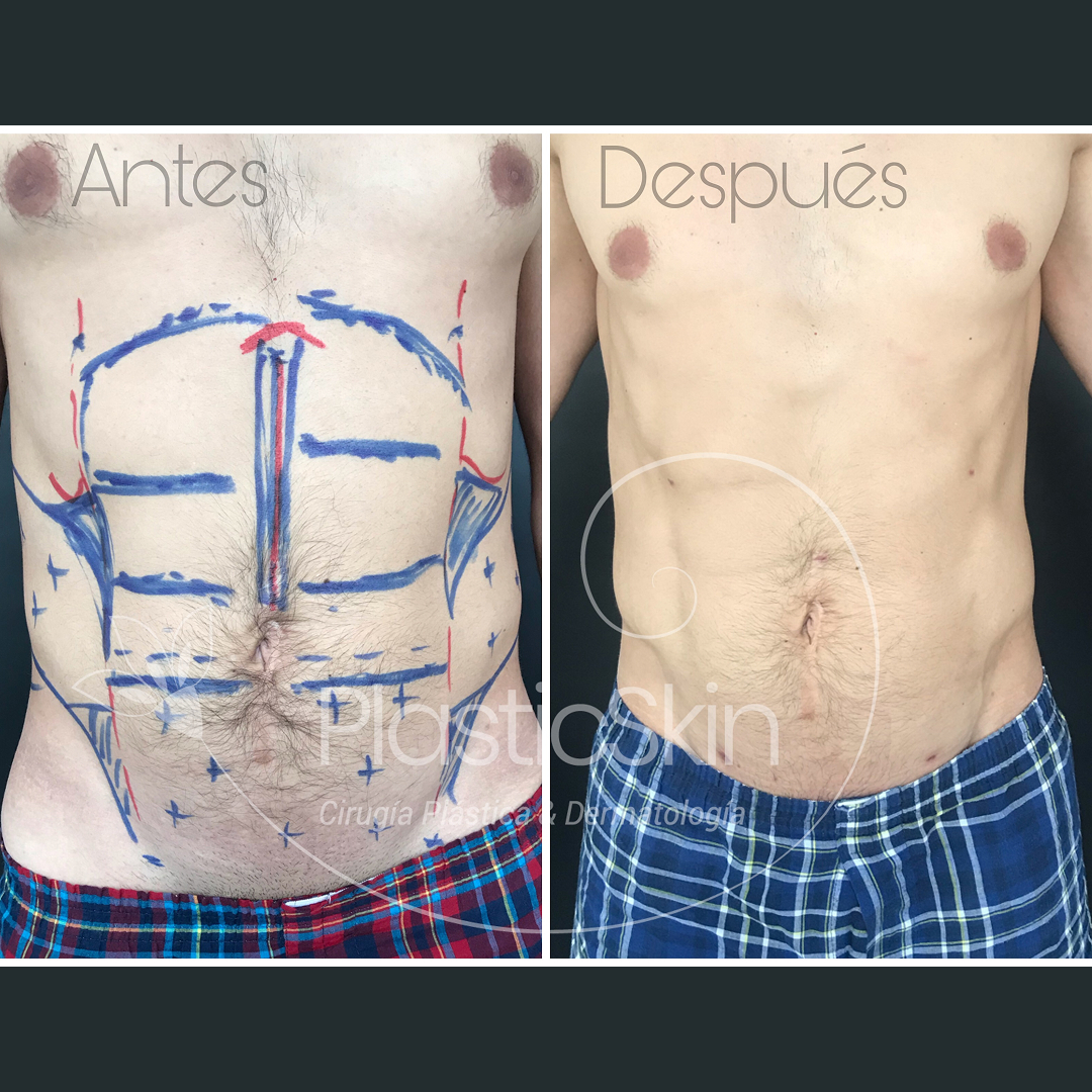 Contorno Abdominal