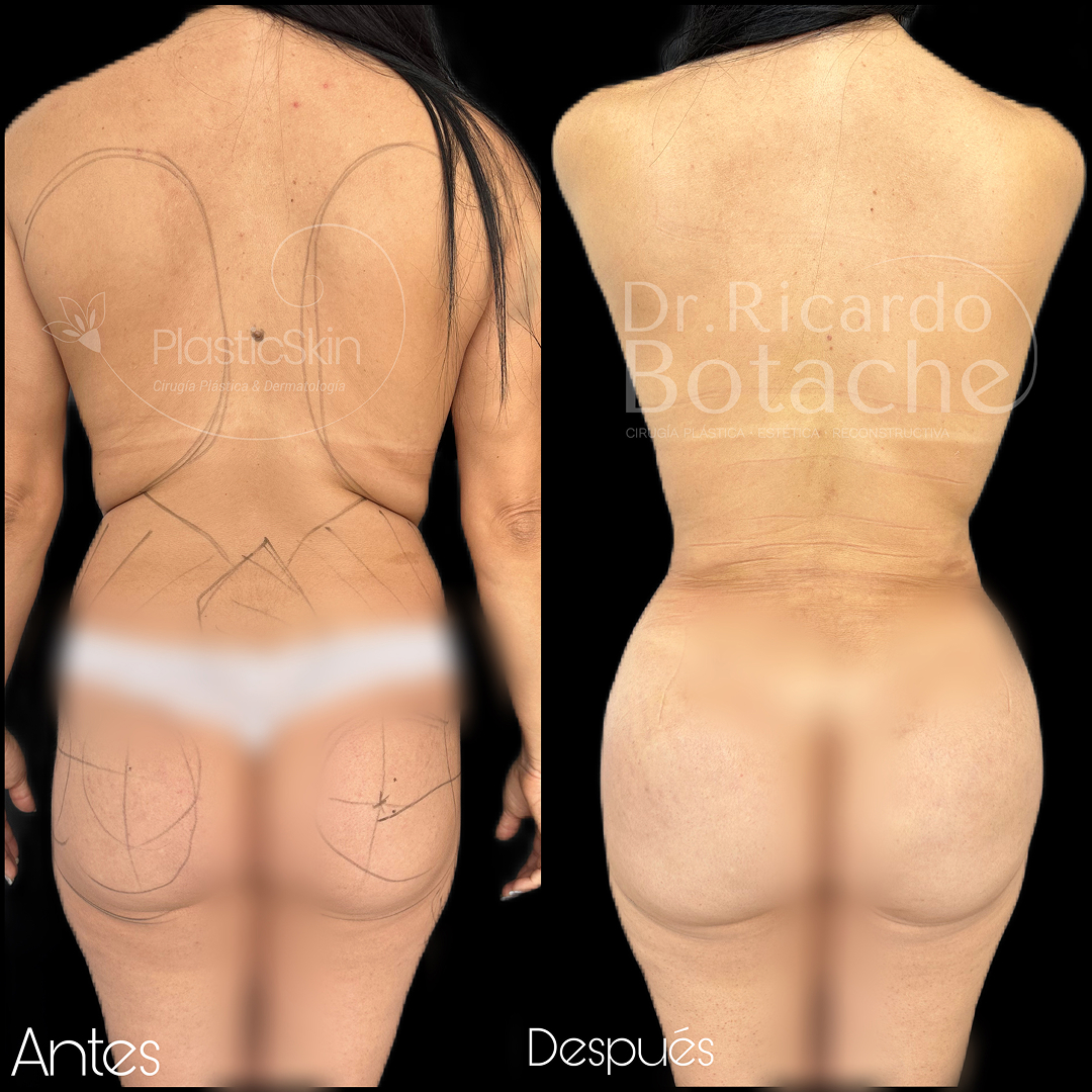 Contorno Abdominal