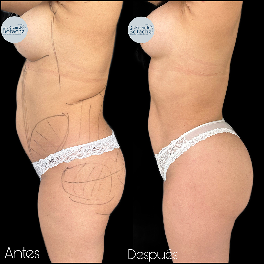 Contorno Abdominal
