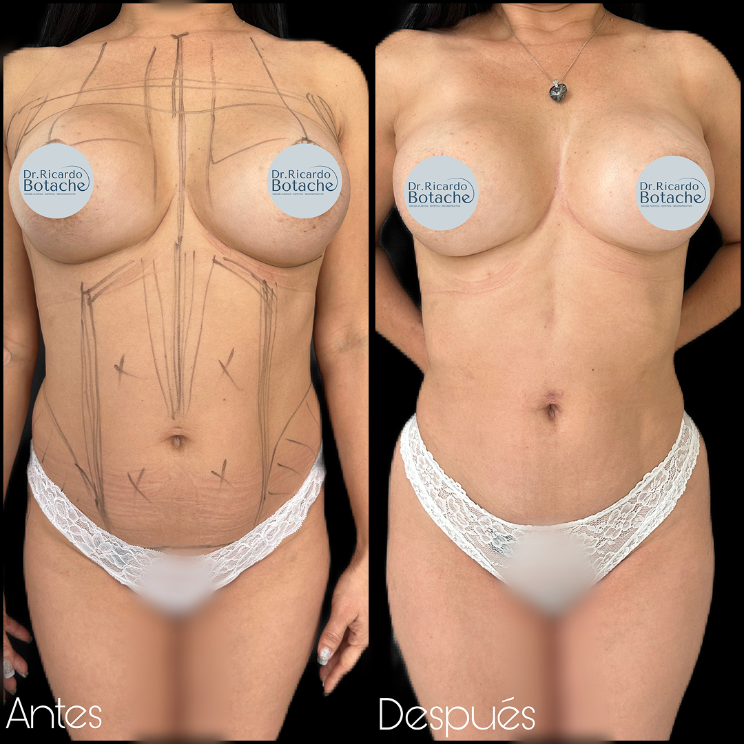 Contorno Abdominal