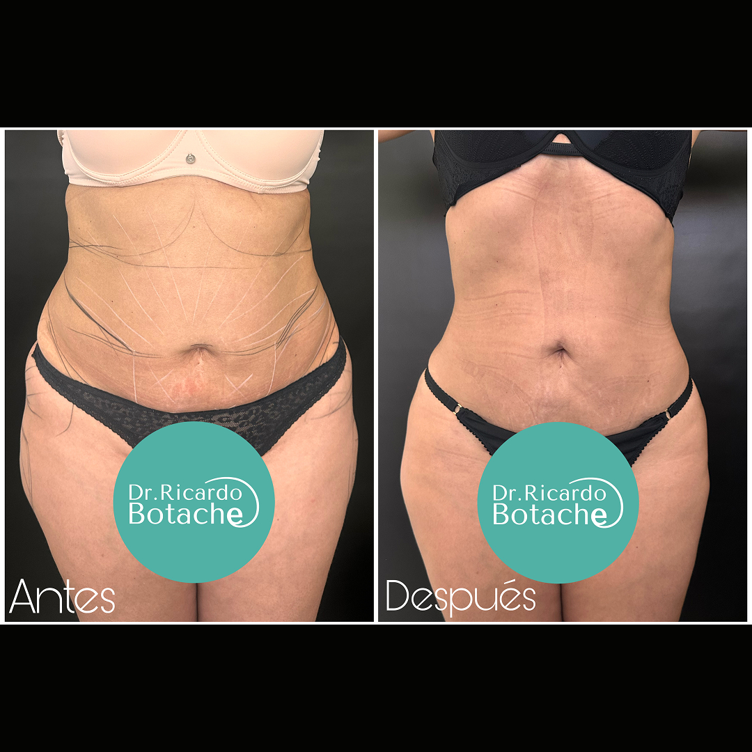 Contorno Abdominal