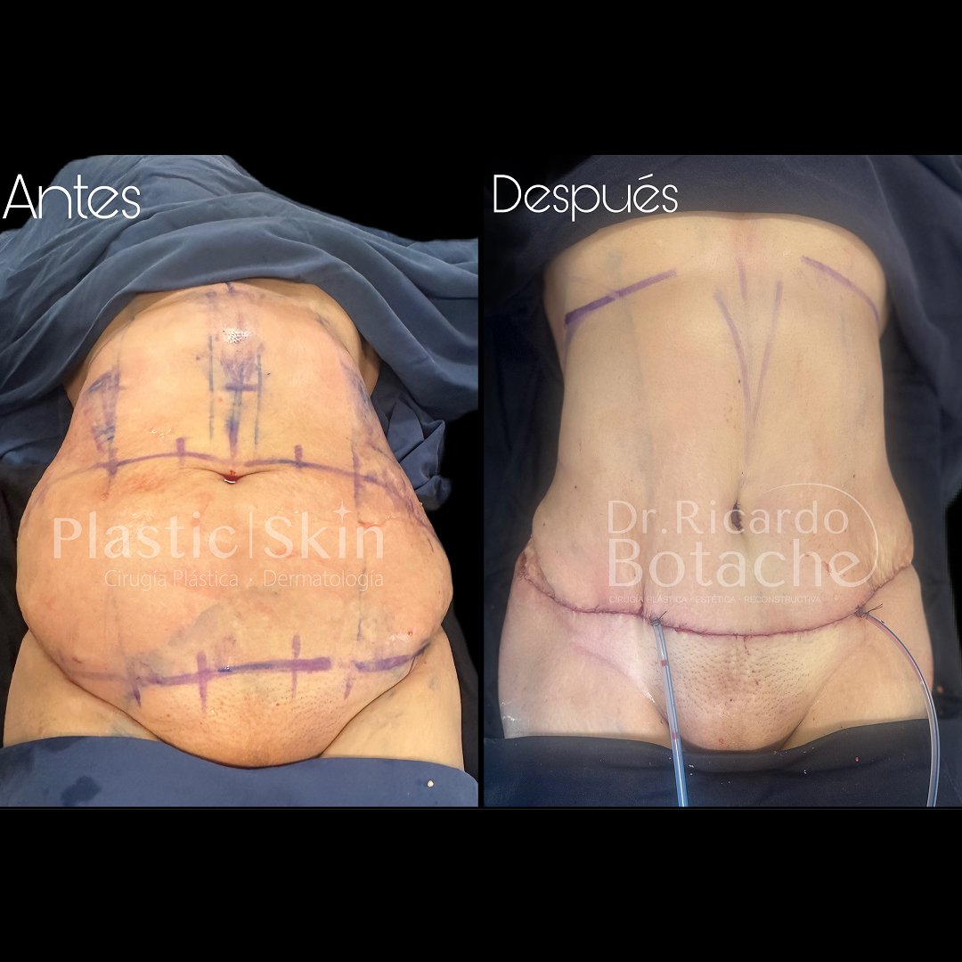 Contorno Abdominal