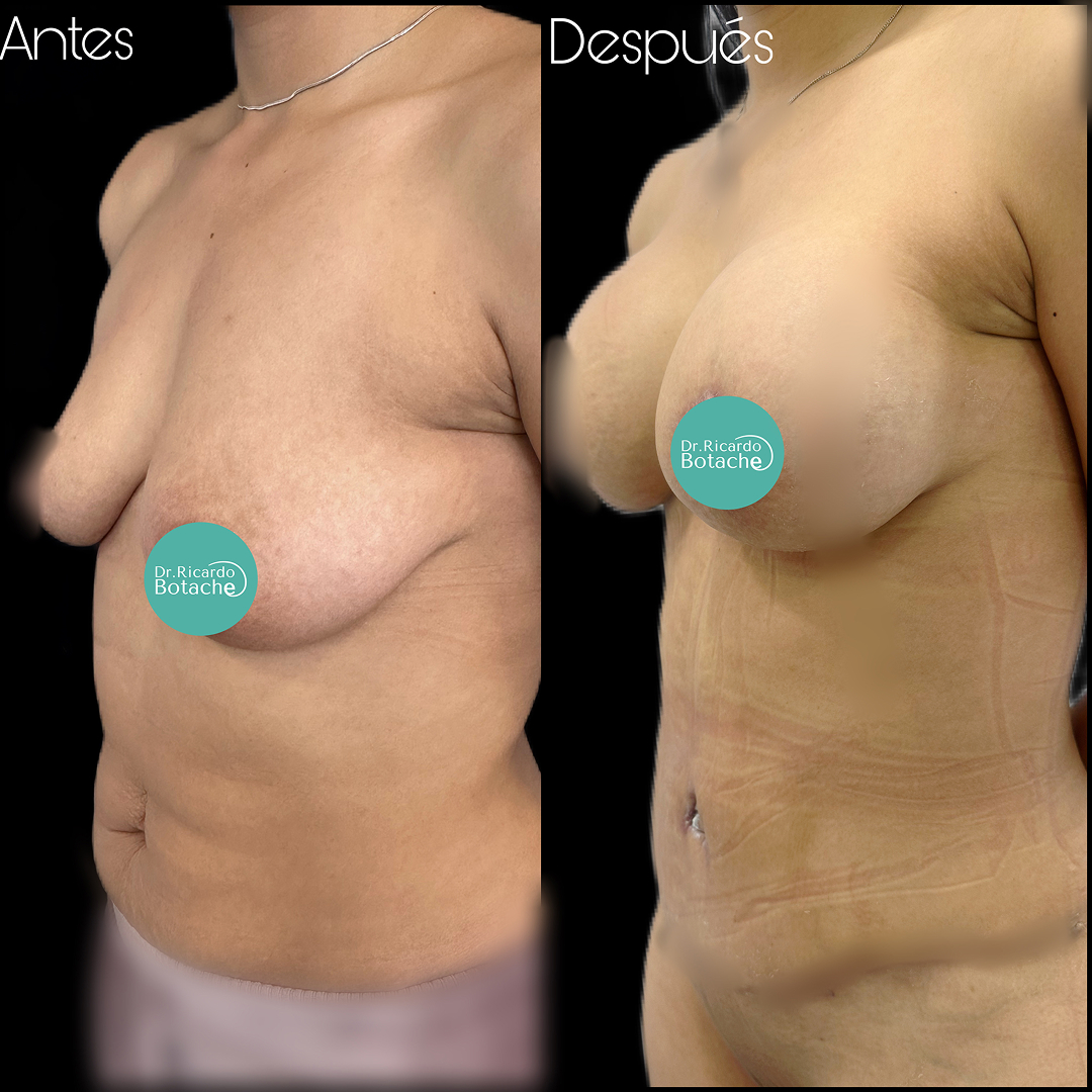 Contorno Abdominal