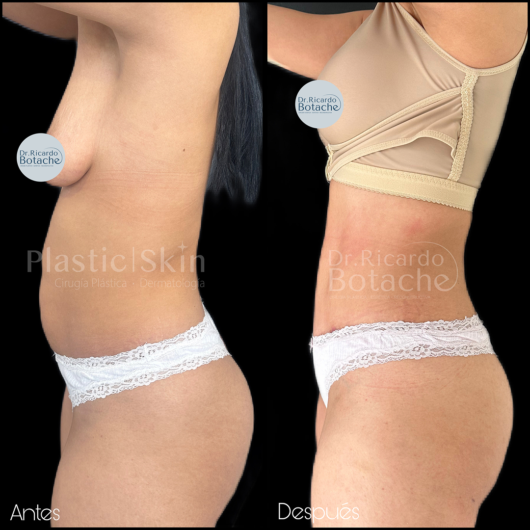 Contorno Abdominal