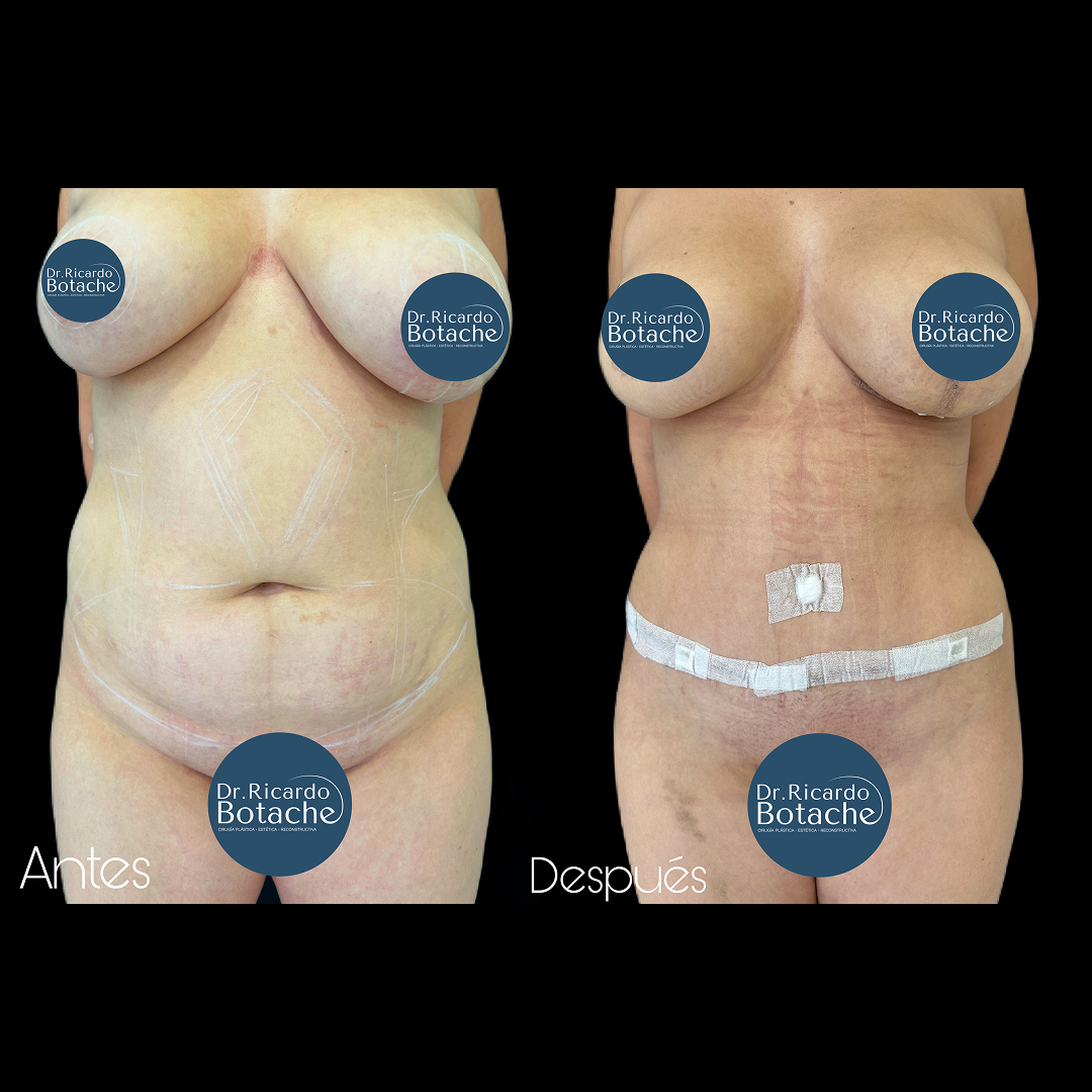 Contorno Abdominal
