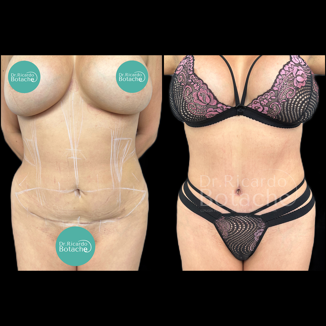 Contorno Abdominal
