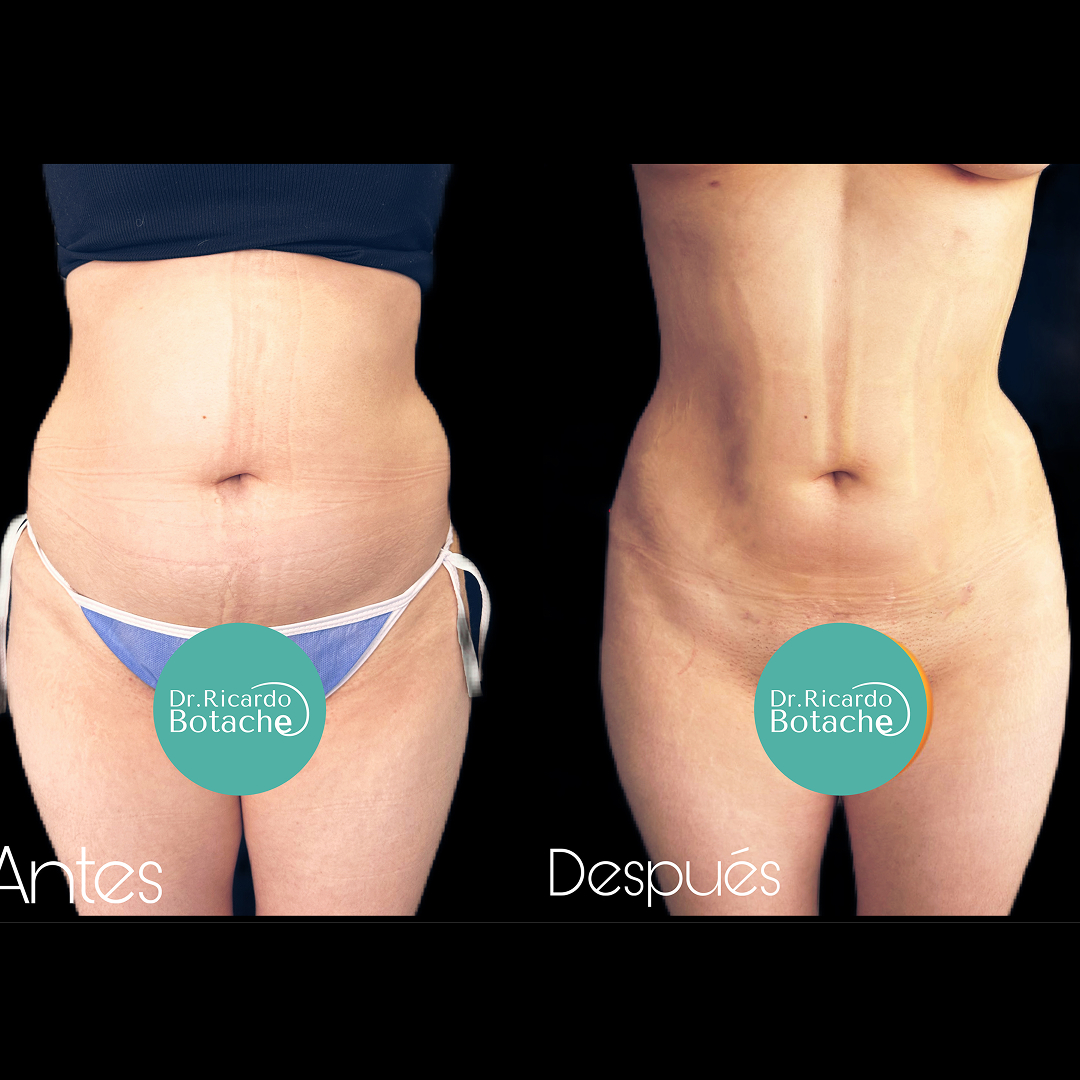 Contorno Abdominal