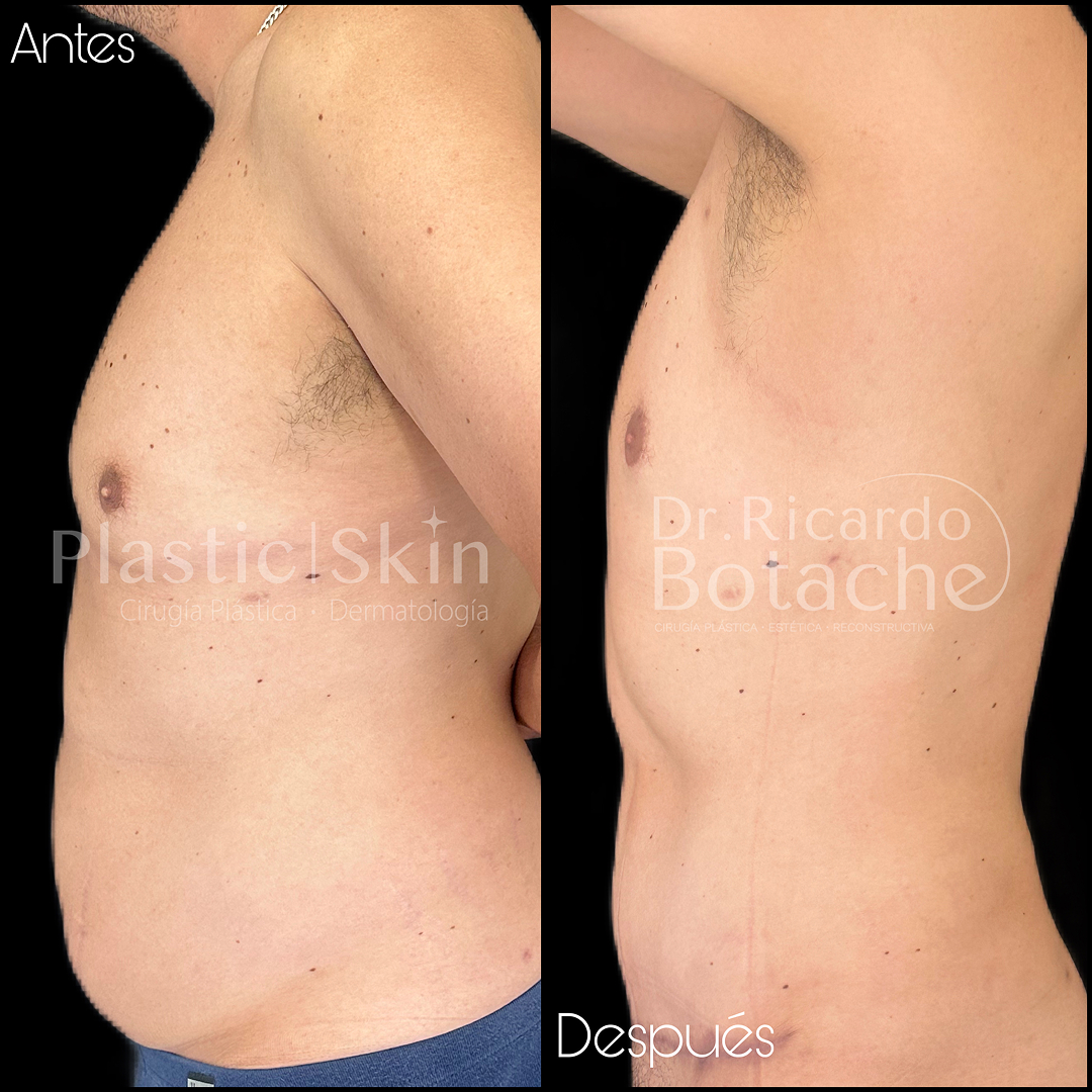 Contorno Abdominal