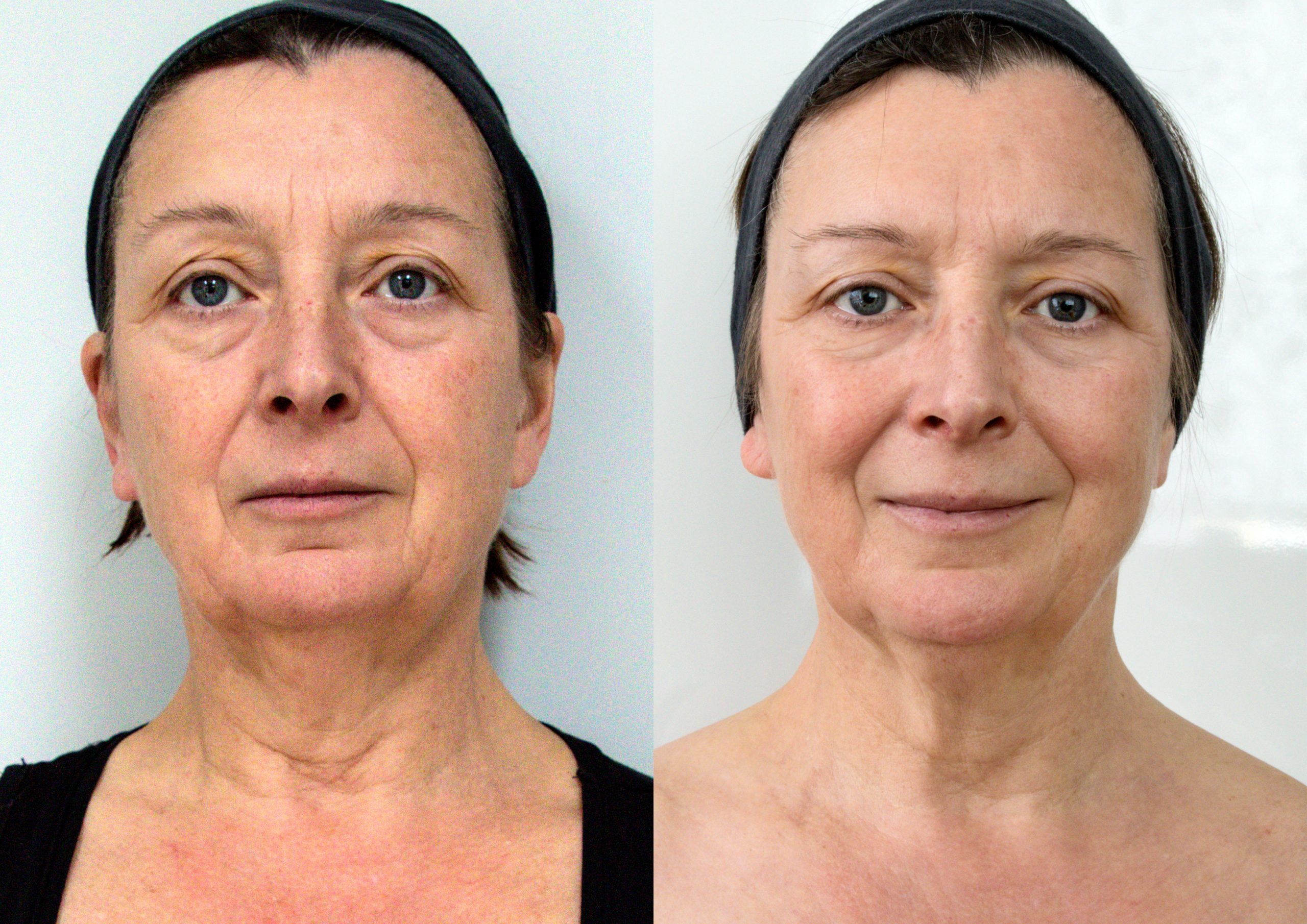 Láser Clearlift Q-Switch