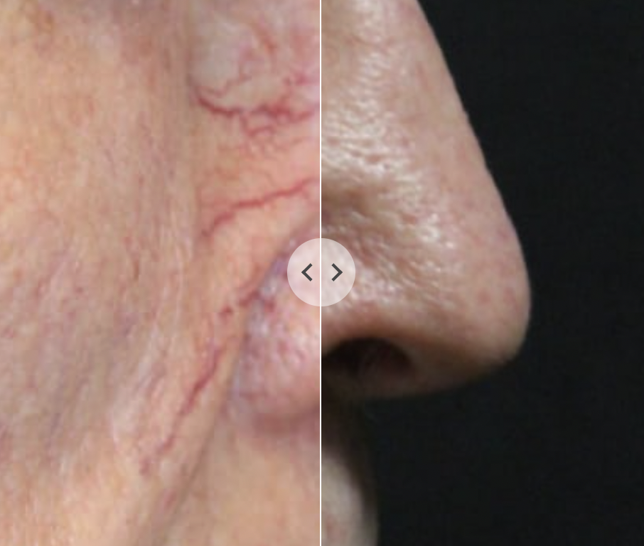 Láser Clearlift Q-Switch