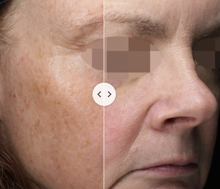 Láser Clearlift Q-Switch