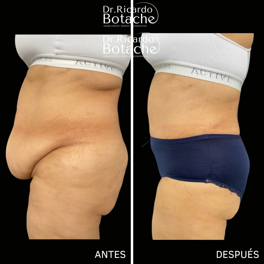 Resultado de contorno abdominal