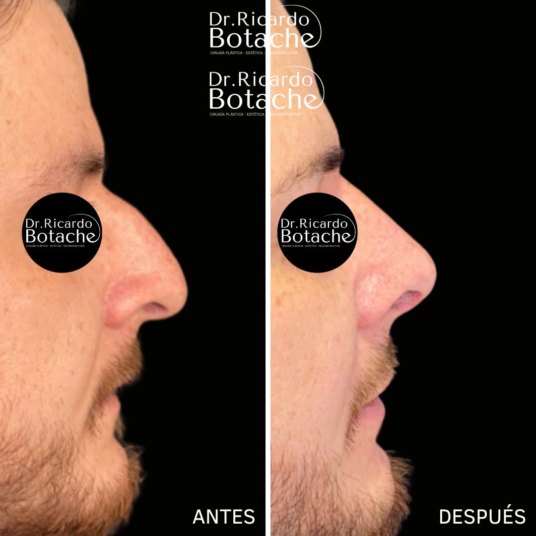 Antes y después de rinoplastia