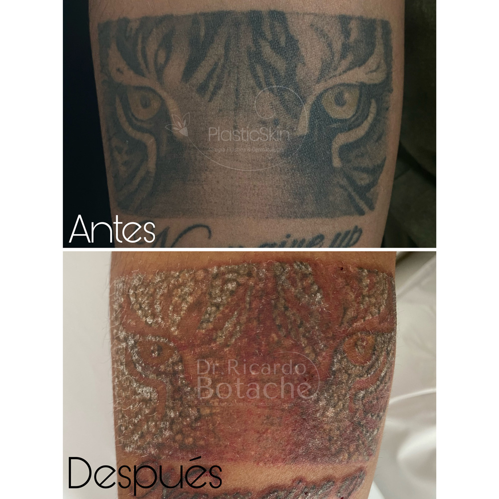 Remoción de Tatuajes